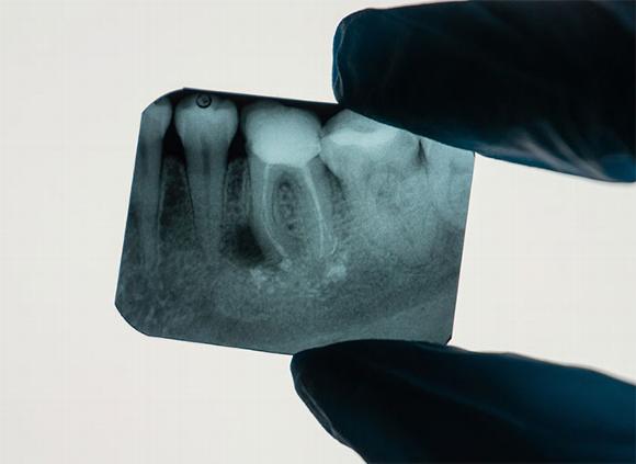 tooth root xray held up by dentist
